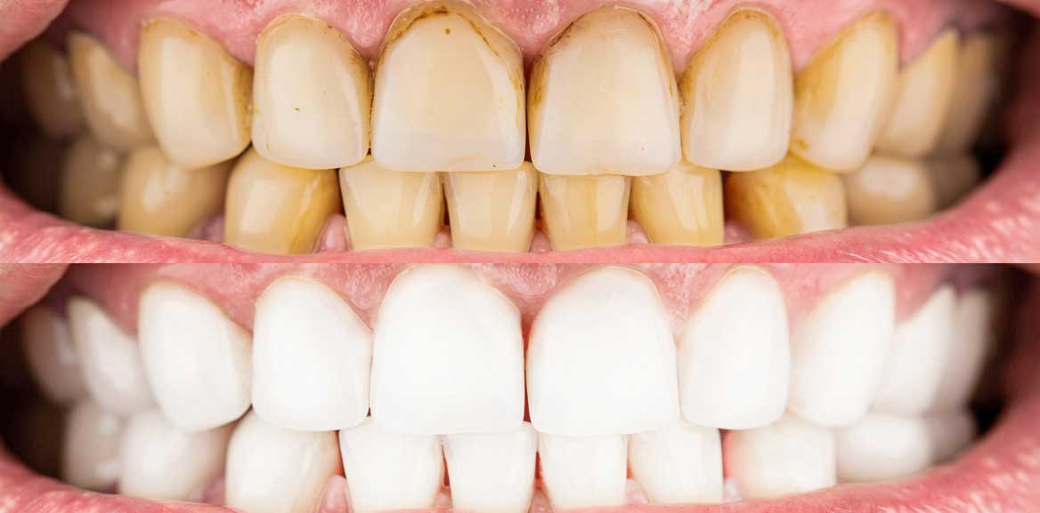 Impact de la drogue et du tabac sur les dents - Alliance Laser